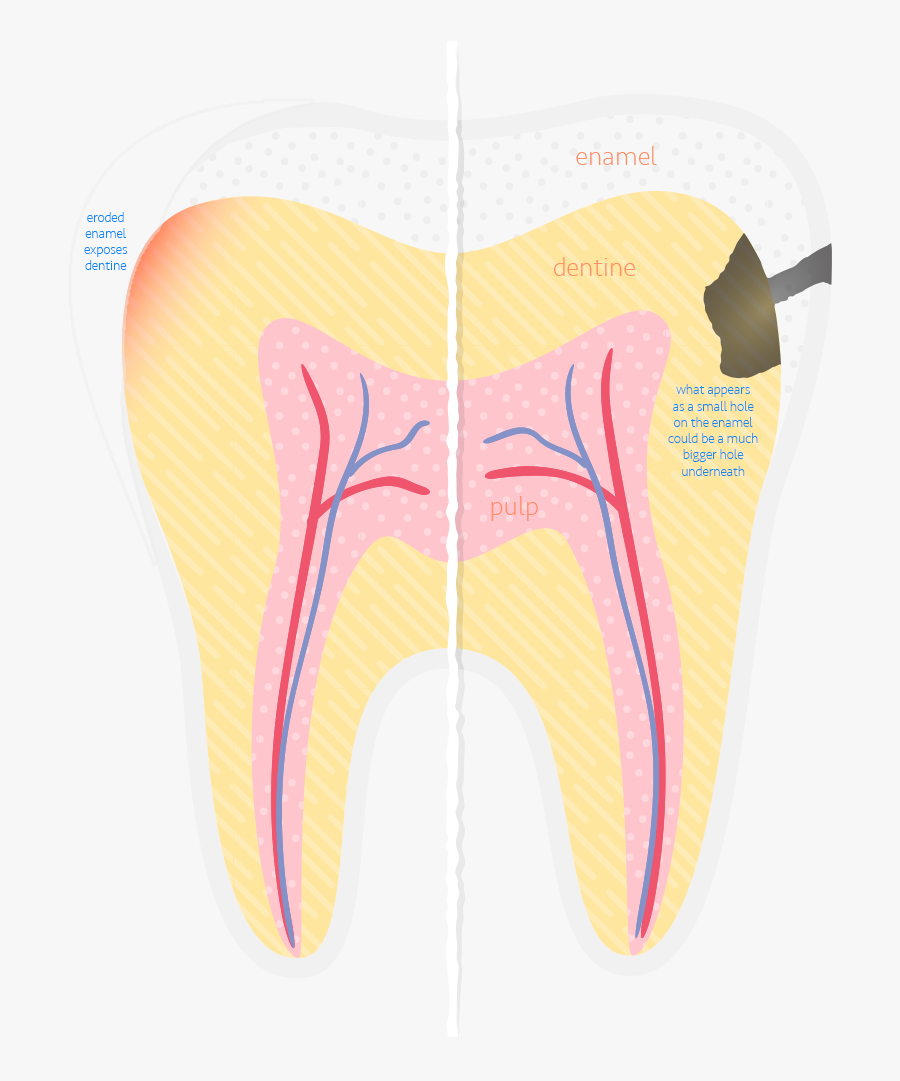 Erosion Decay"
				 Data Appear Animation="fadein - Energy Drink Teeth Damage, Transparent Clipart