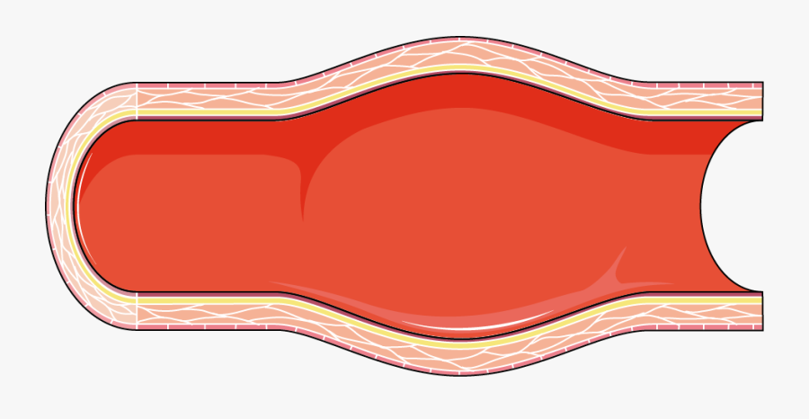 Clip Art Dilated Servier Medical Art - Artery Clipart Png, Transparent Clipart