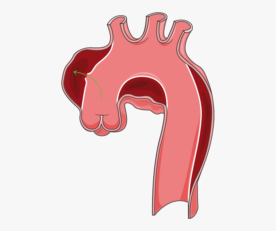 Anévrisme, Transparent Clipart