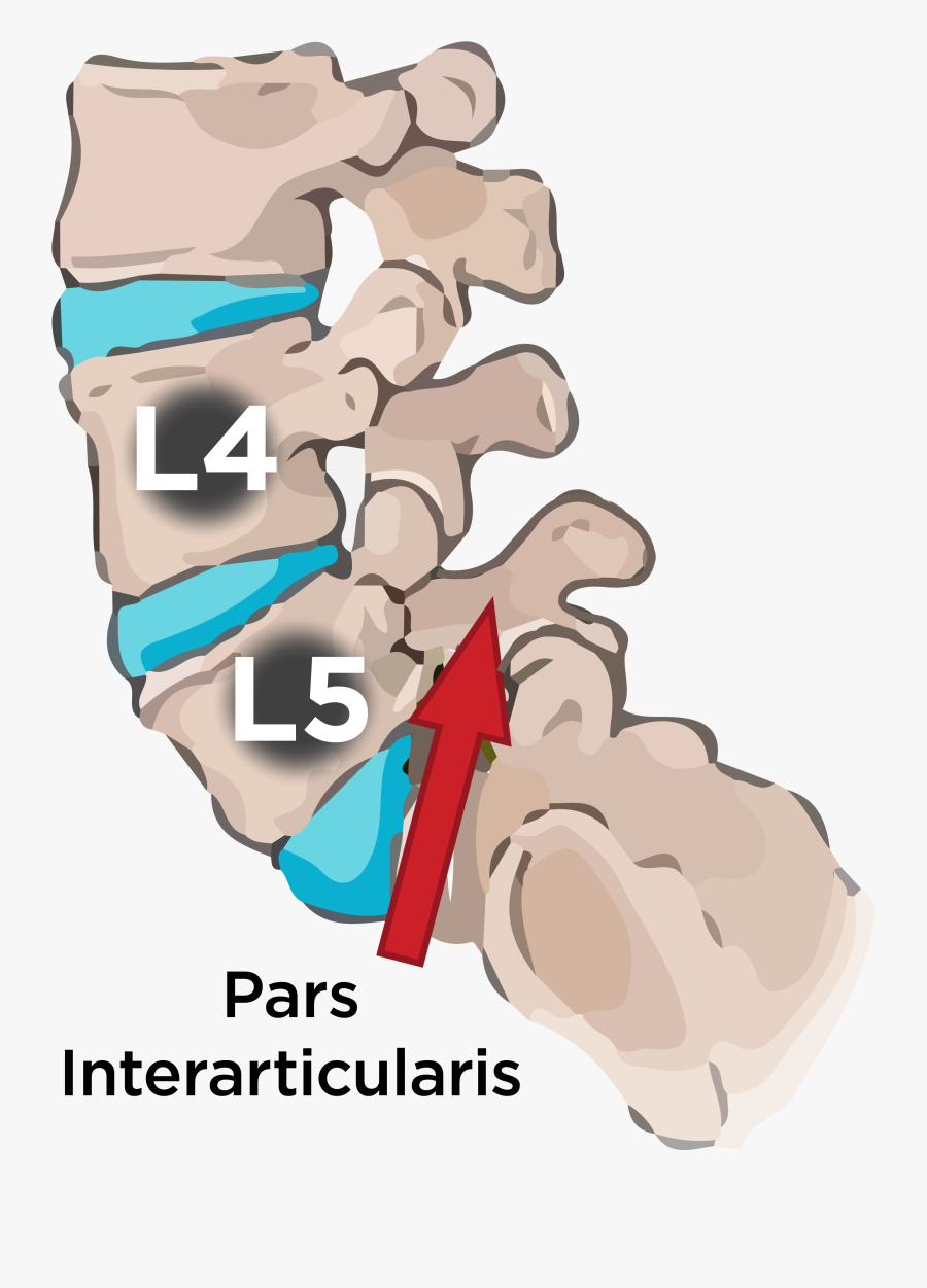 Injury Clipart Break Leg - L5 Pars Defect, Transparent Clipart