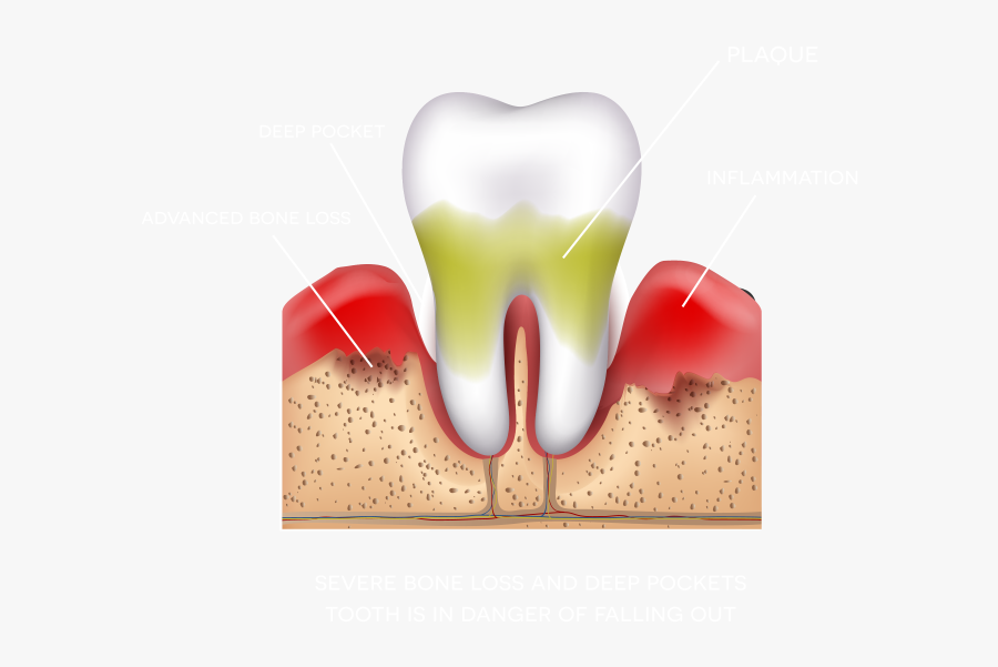 Advanced Periodontitis Illustration - Periodontal Disease Causes, Transparent Clipart