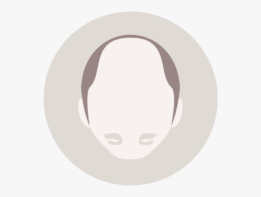 Loss Clipart Hair Fall - Circle, Transparent Clipart