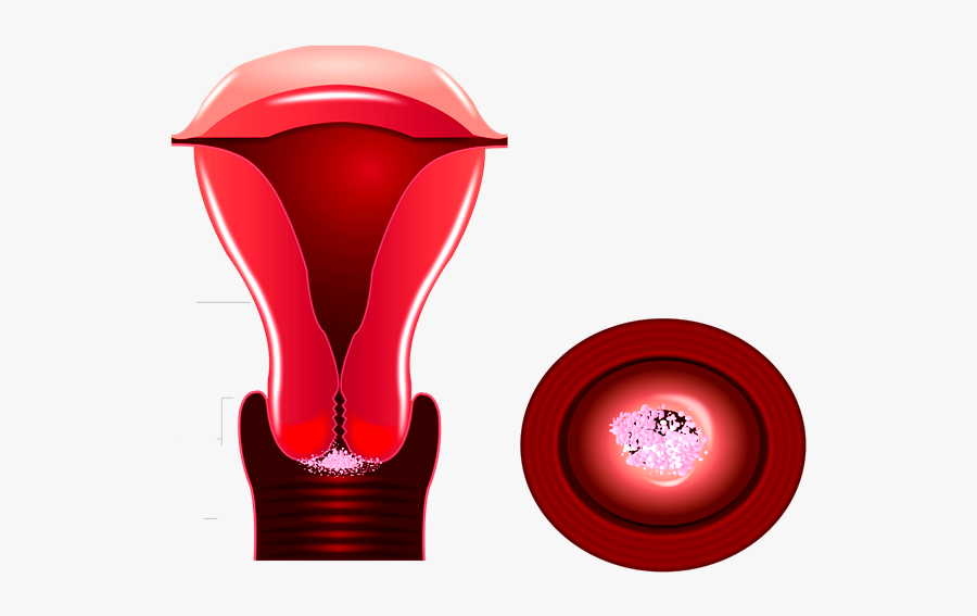 Cáncer Cervicouterino, Transparent Clipart