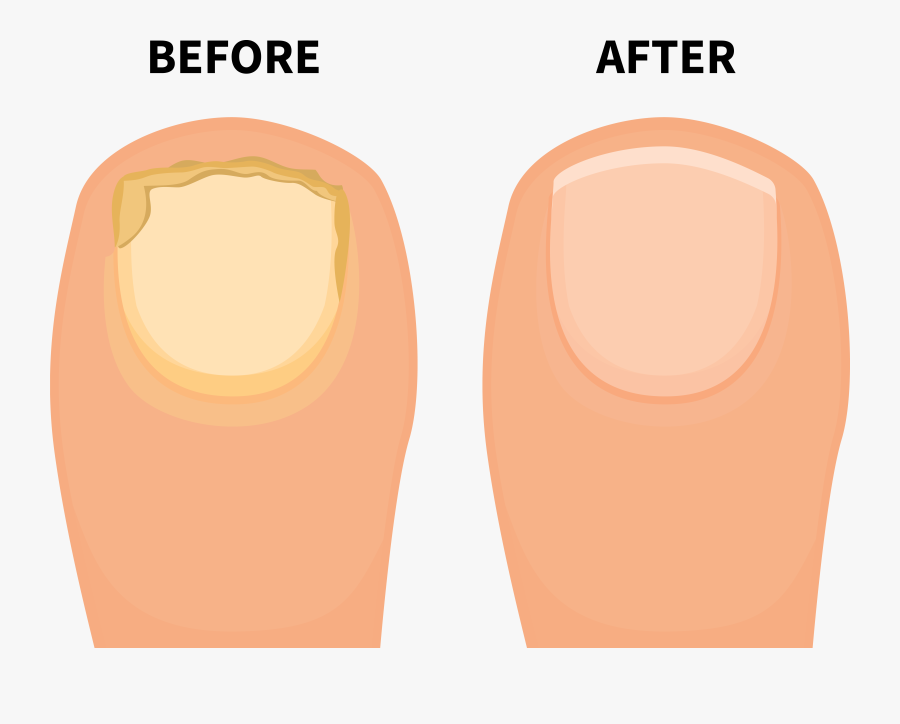 Toe Funges Before After - Big Toe Vector, Transparent Clipart