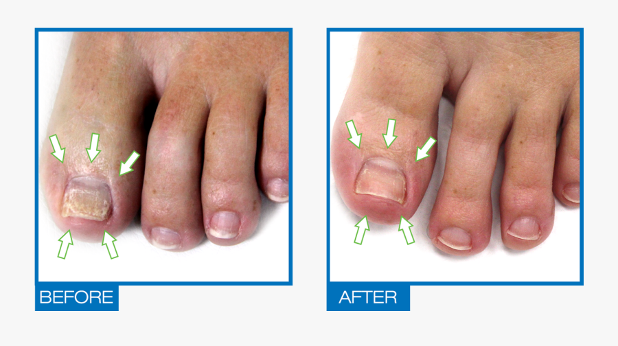 Transparent Fingernail Png - New Nail Growth After Fungus, Transparent Clipart