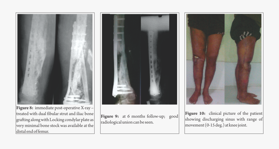 Transparent Femur Png - Fibular Strut Graft, Transparent Clipart