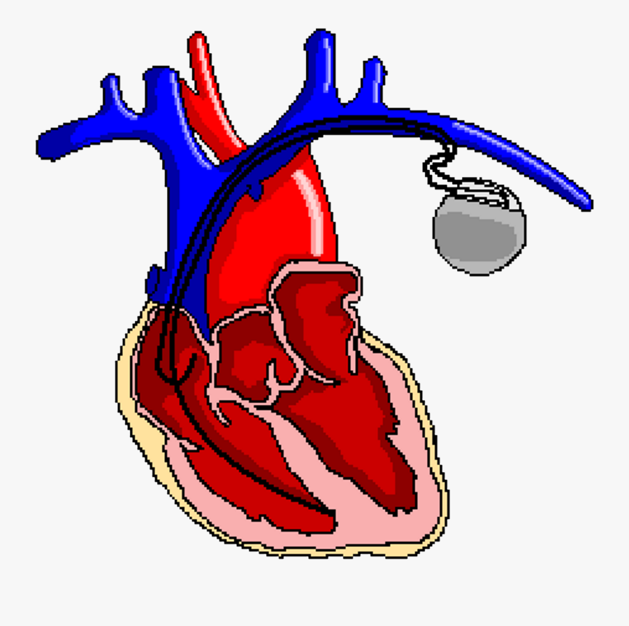 Ppg Change Complications - Pa Ce Maker Varieties, Transparent Clipart