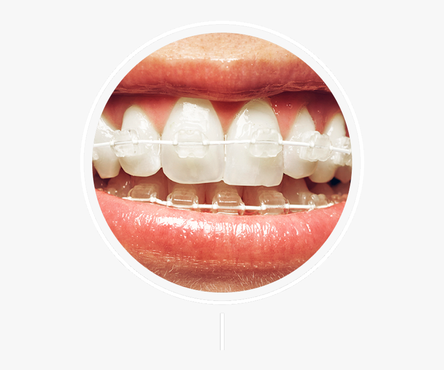 White Braces With Silver Wire, Transparent Clipart