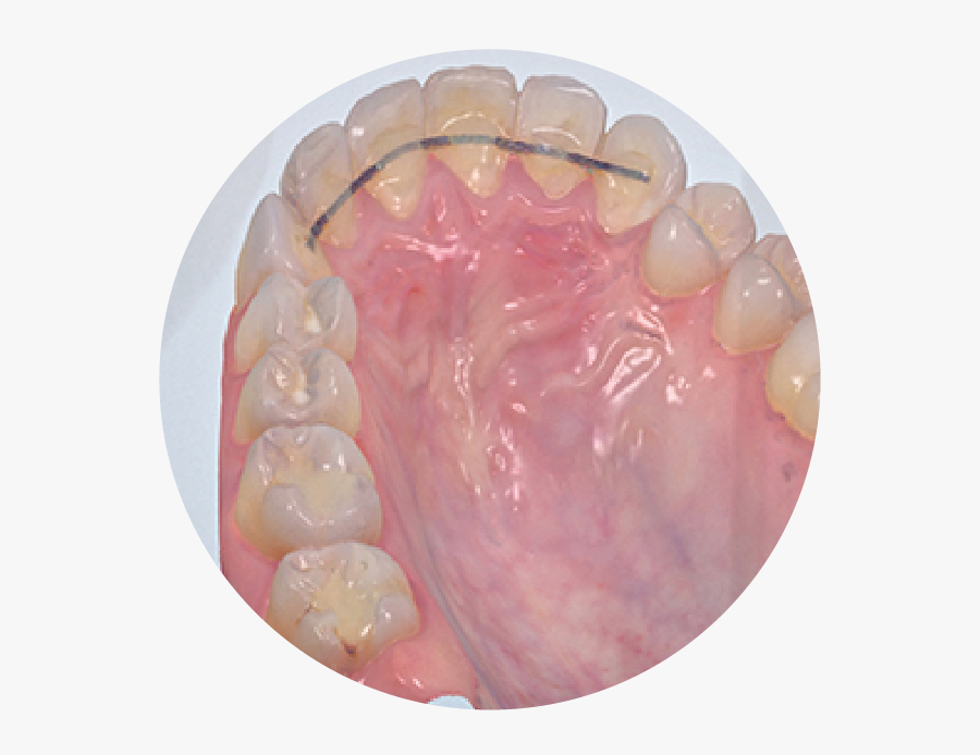 Intraoral - Macro Photography, Transparent Clipart