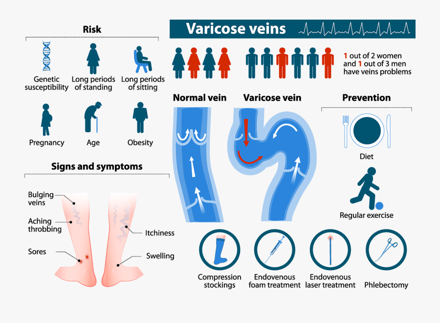 Varicose Veins Infographic Web - Varicose Veins Risk Factors, Transparent Clipart