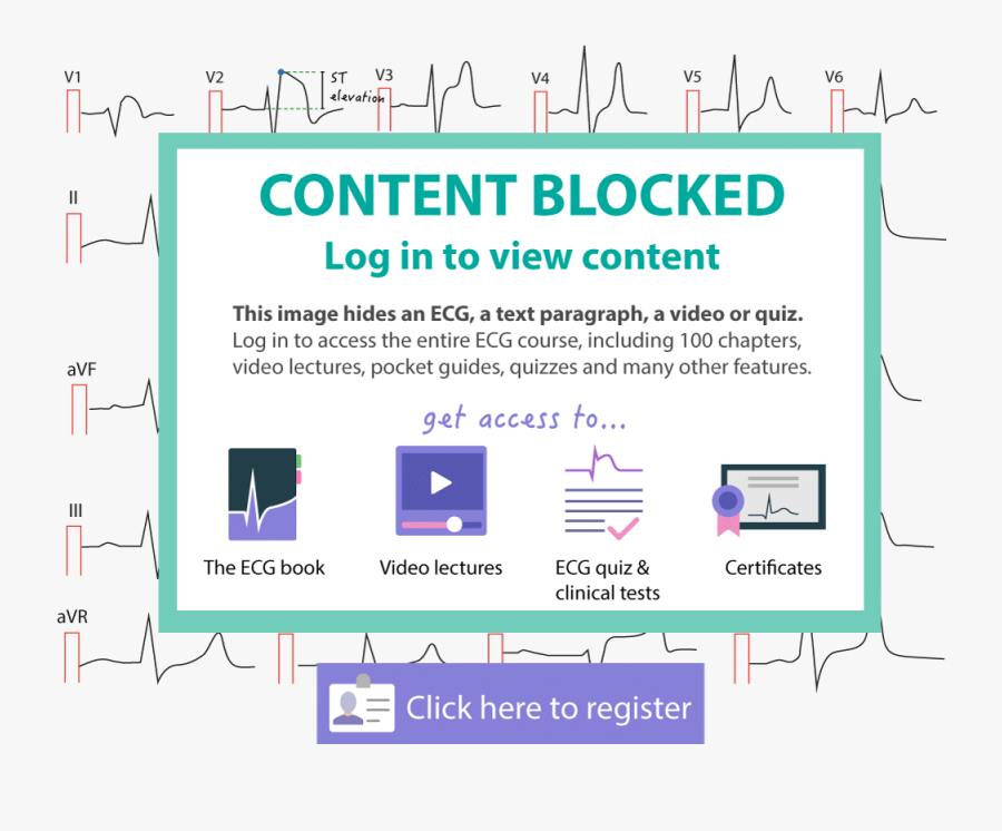St Elevation Myocardial Infarction - Gas Agency, Transparent Clipart
