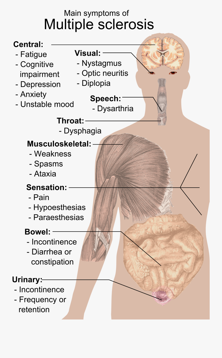 Multiple Sclerosis Ms Diagram, Transparent Clipart