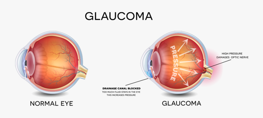 Glaucoma Ophthalmology, Transparent Clipart