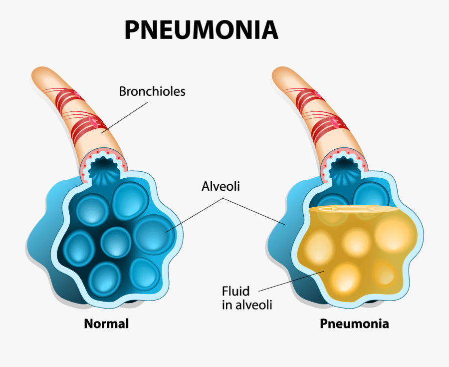 Pneumonia Alveoli, Transparent Clipart