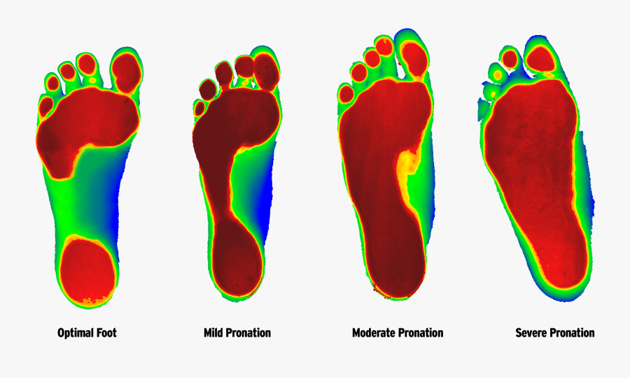 Foot Ranging From Least Severe To Most According To, Transparent Clipart