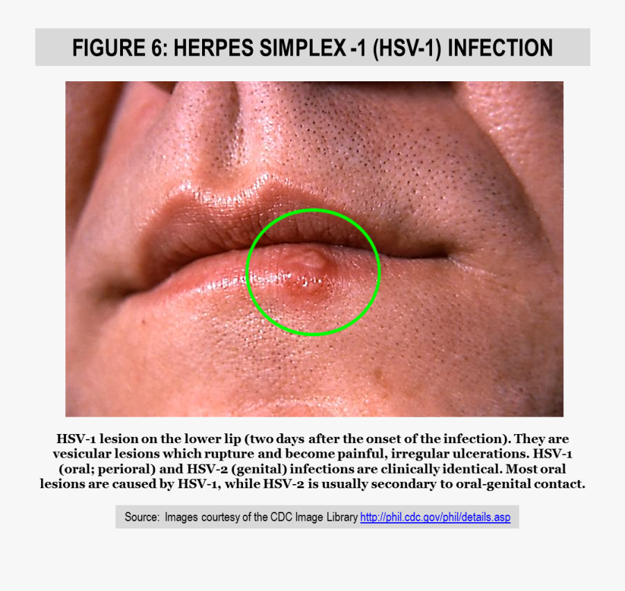 Clip Art Male Genital Herpes Pictures - Herpes On The Lower Lip, Transparent Clipart