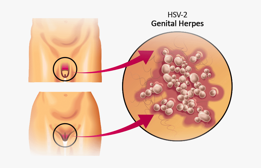 Clip Art Male Genital Herpes Pictures - Know If You Have Genital Herpes, Transparent Clipart
