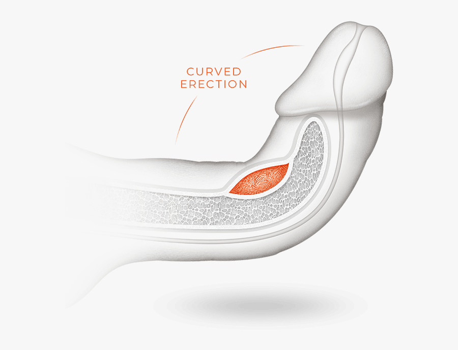 Peyronie"s Disease Is Caused By A Buildup Of Scar Tissue - Curved Penis Disease, Transparent Clipart