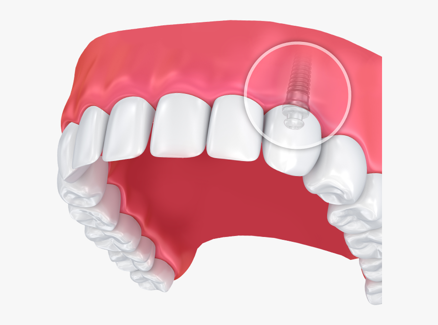 Implant Surgery Recovery Tips - Do I Have Small Teeth, Transparent Clipart