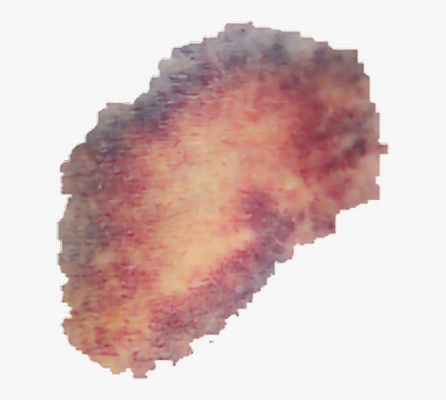 Bruise Transparent Bruises Png , Transparent Cartoons - Bruise Png