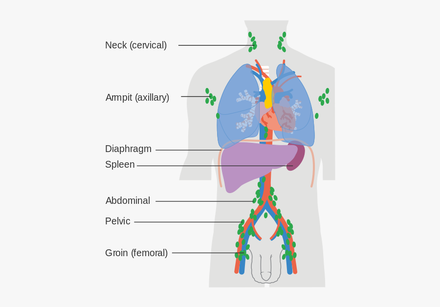 Non Hodgkin's Lymphoma, Transparent Clipart