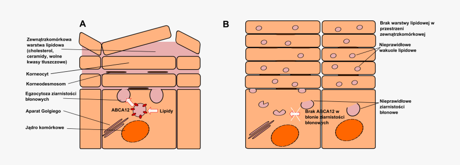 Clip Art Diagram Of Another Wiring - Harlequin Ichthyosis Vs Normal Skin, Transparent Clipart