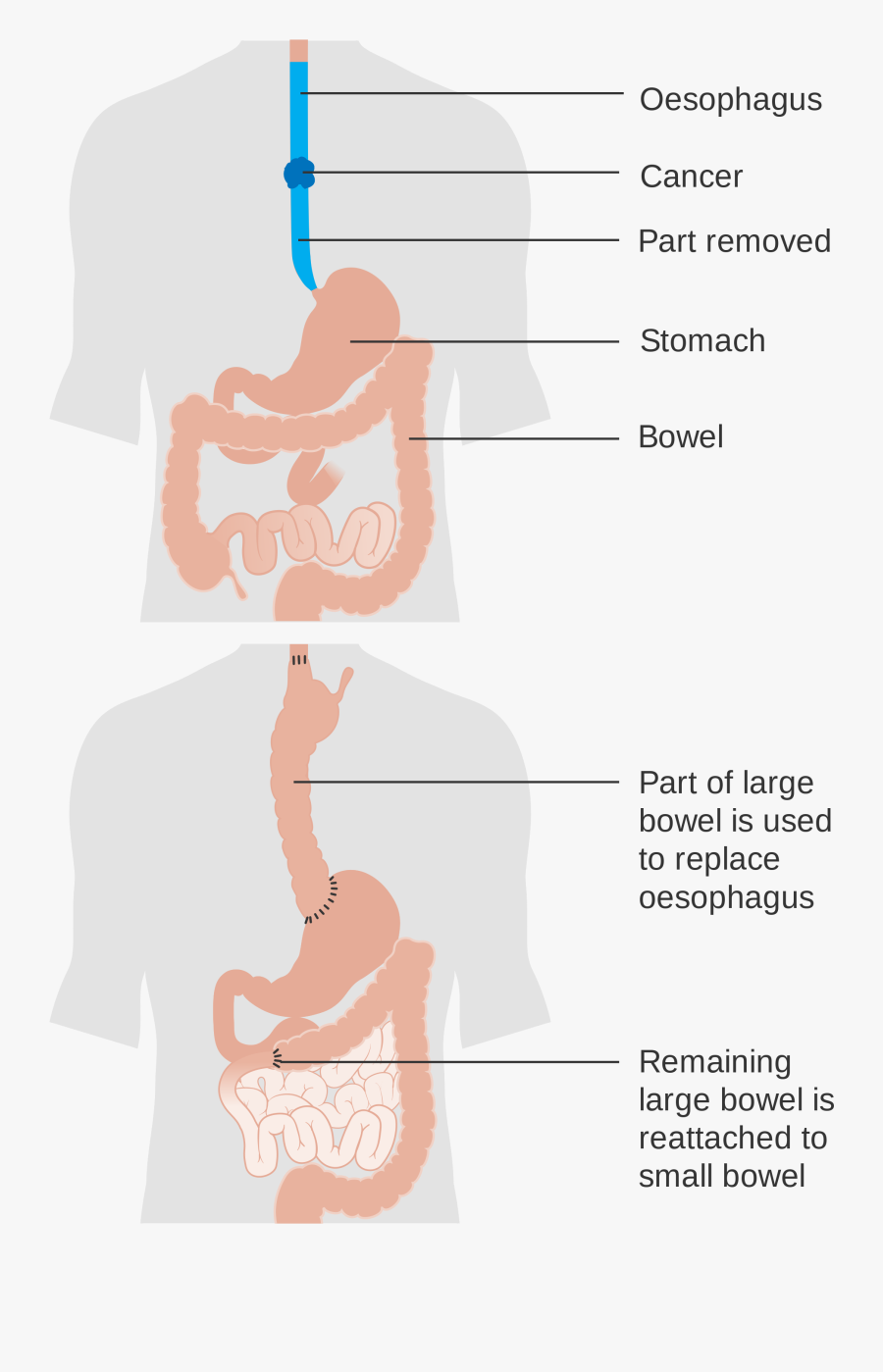 Stomach Size After Esophagectomy , Transparent Cartoons - Illustration, Transparent Clipart