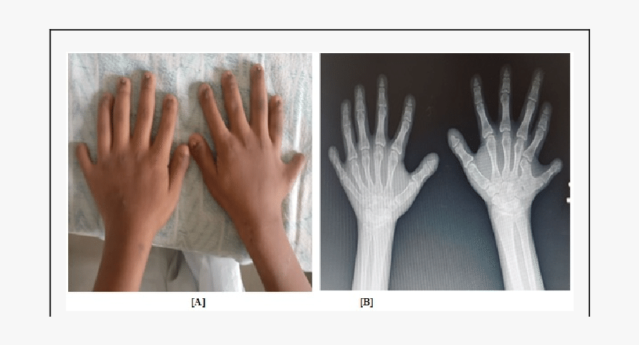 Clip Art A Six Fingers In - Radiography, Transparent Clipart