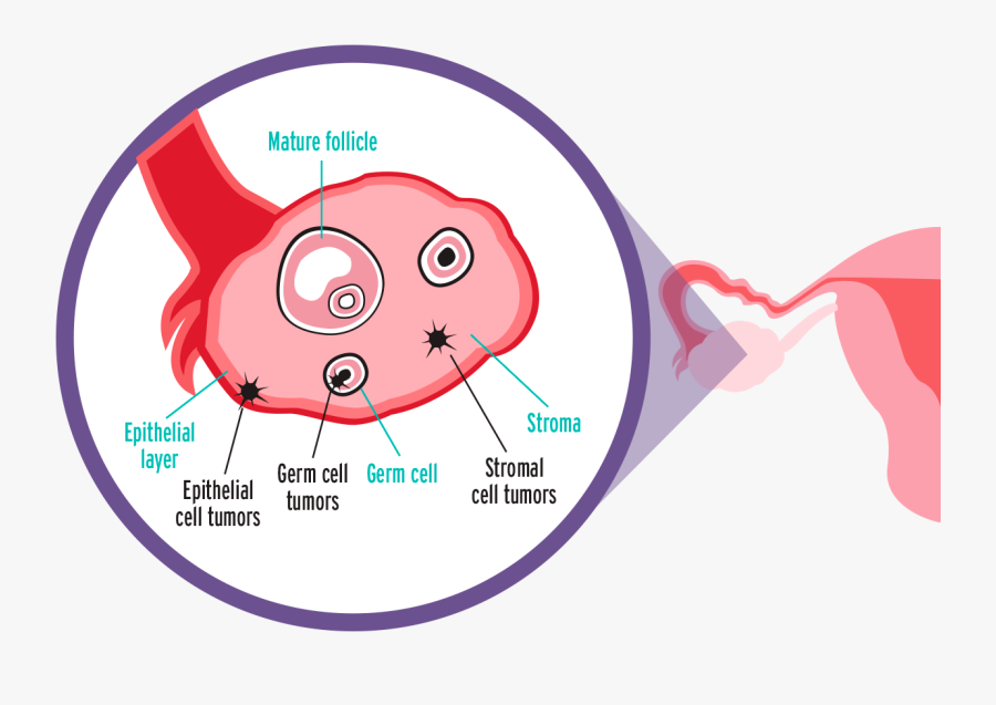 Ovarian Cancer Clipart, Transparent Clipart