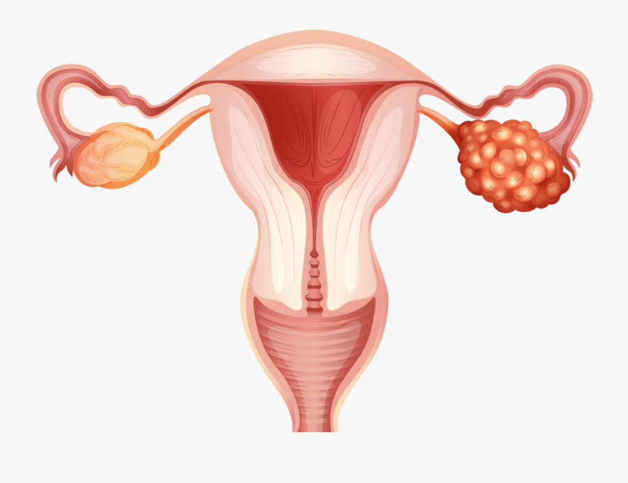 Ovarian Cancer Vector, Transparent Clipart
