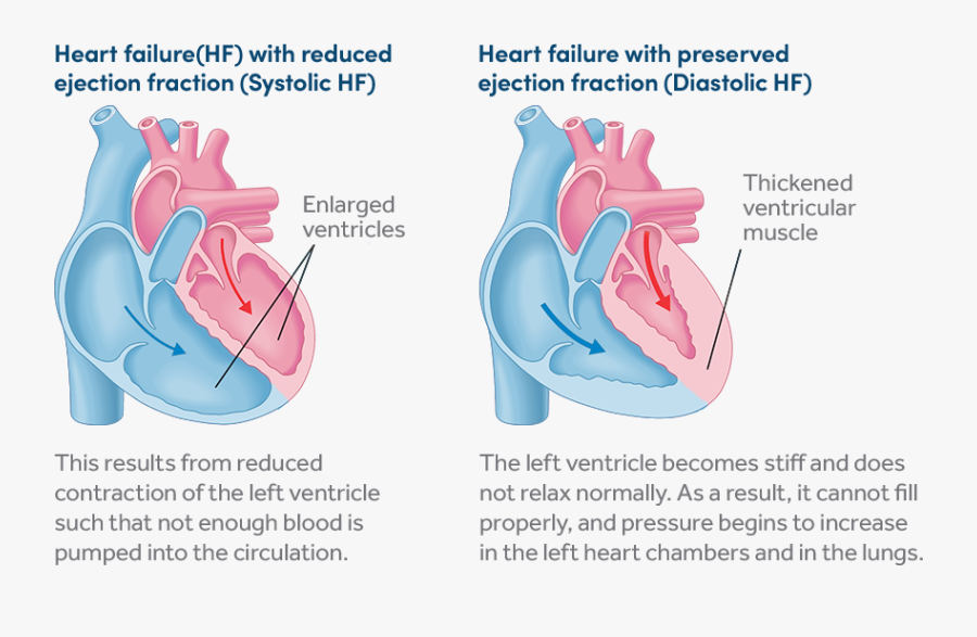 Transparent Heart Organ Png - Heart Failure Diagram, Transparent Clipart