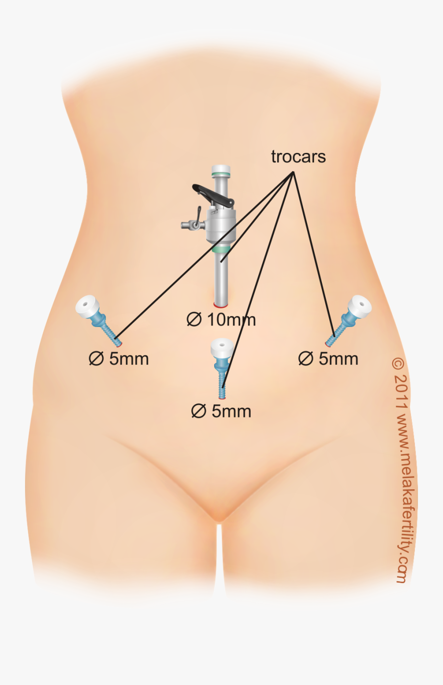 Clip Art Appendix Scar - Port Placement For Laparoscopic Hysterectomy, Transparent Clipart