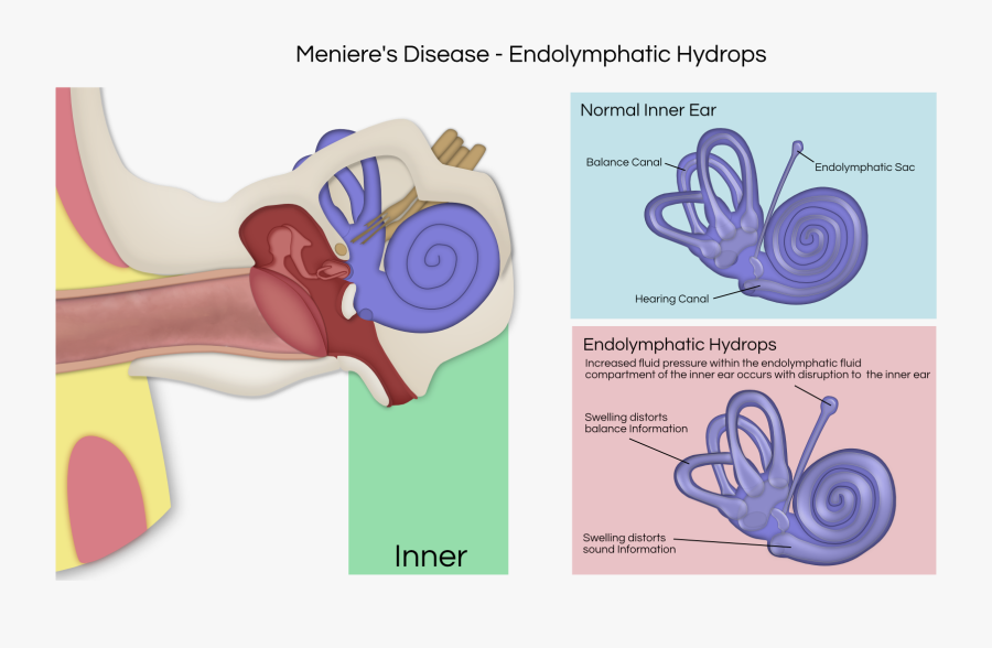 Transparent Canal Clipart - Vestibular Schwannoma Affected Nerves, Transparent Clipart