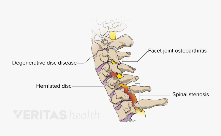 Clip Art How Cervical Degenerative Disc - Spinal Disc Problems, Transparent Clipart