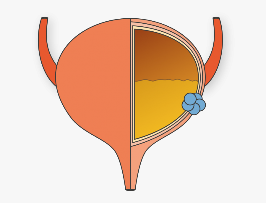 About Bladder Cancer - Bladder Cancer Transparent, Transparent Clipart