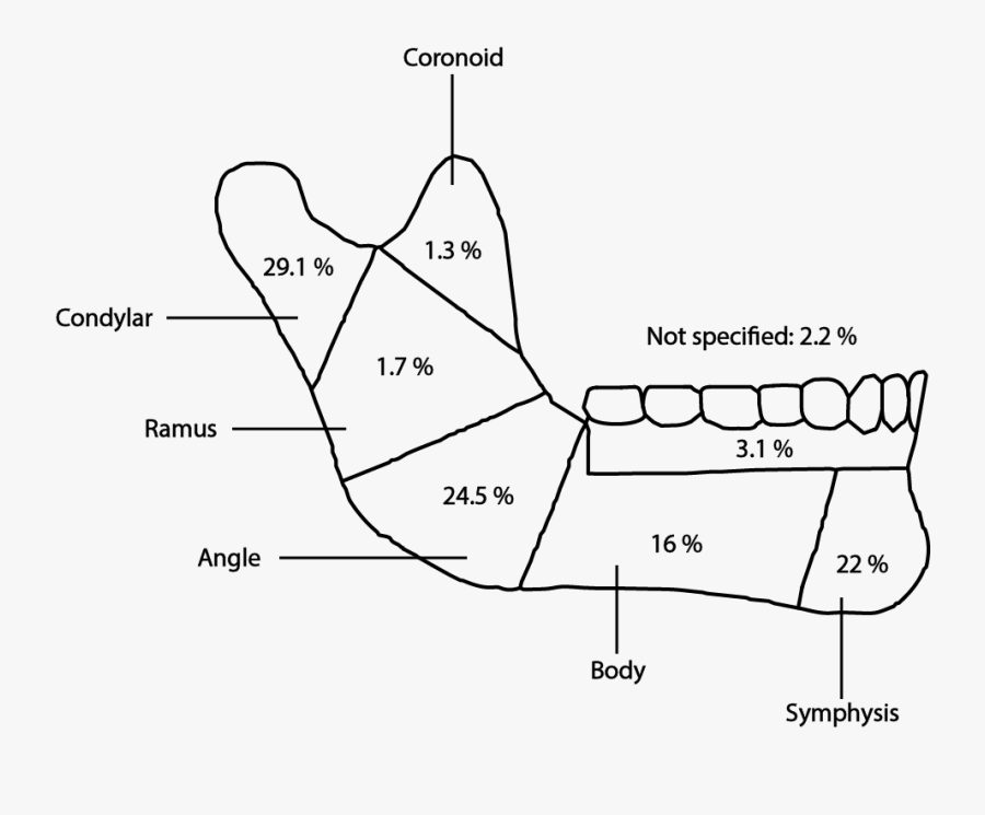 Mandibular Fracture Frequency, Transparent Clipart