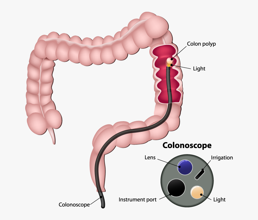 Colonoscopy - Colonoscopy Crohn's Disease, Transparent Clipart