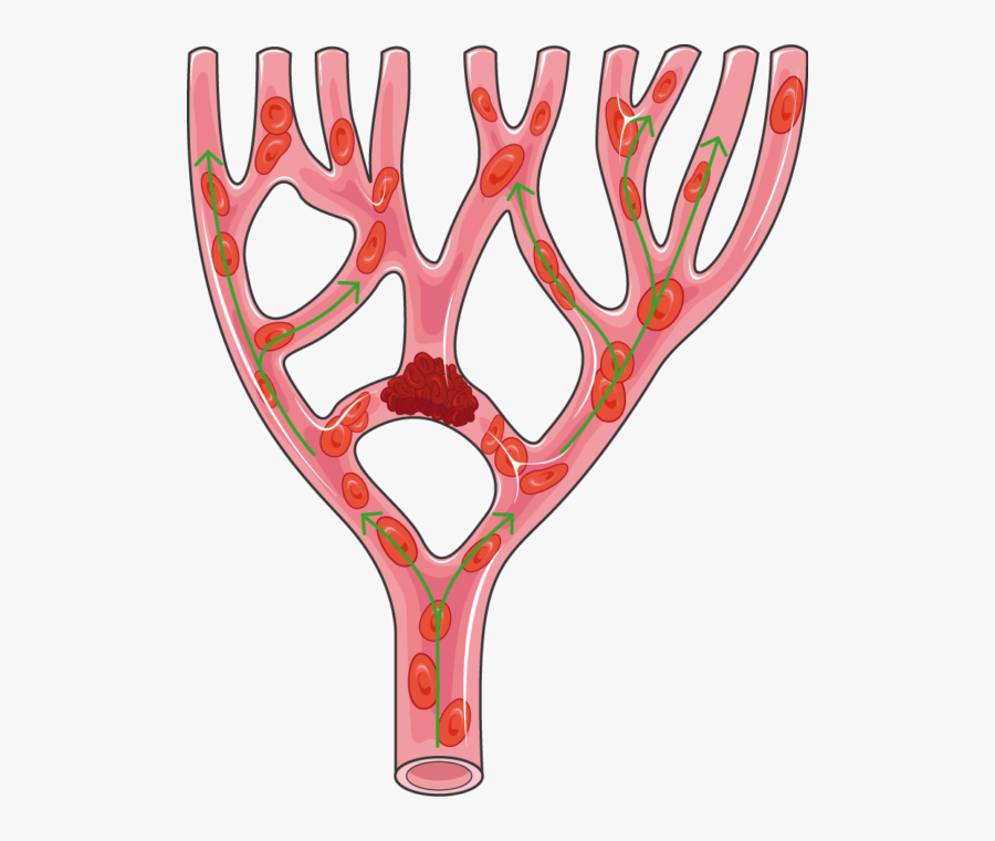 Thrombus Png, Transparent Clipart