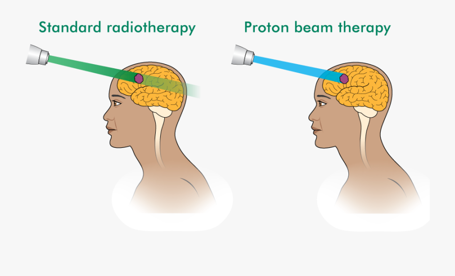 Proton Beam Therapy And Standard Radiotherapy - Proton Beam Therapy Radiation, Transparent Clipart