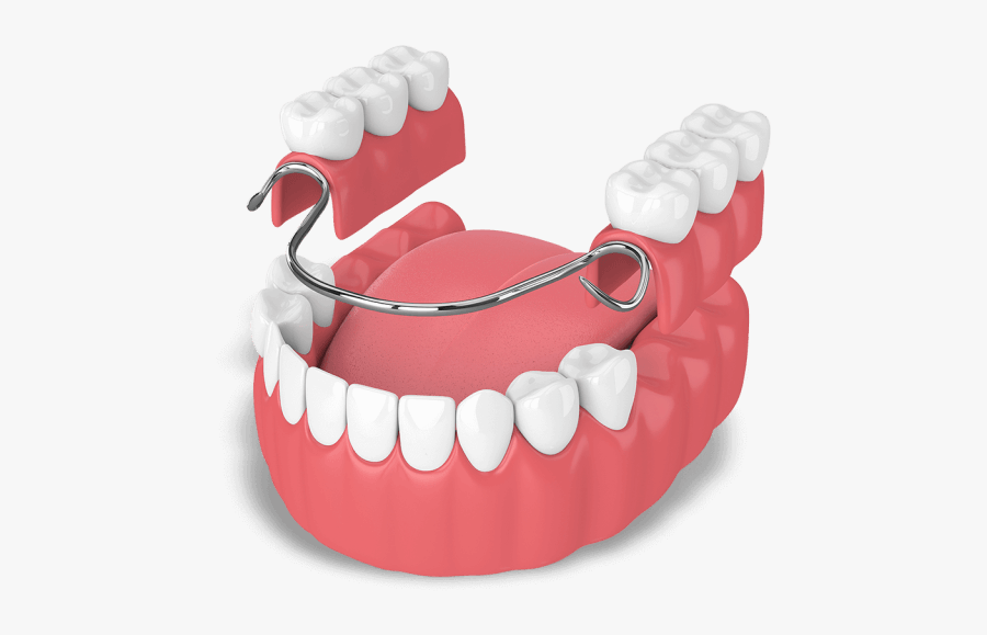 Que Es Una Protesis Dental, Transparent Clipart