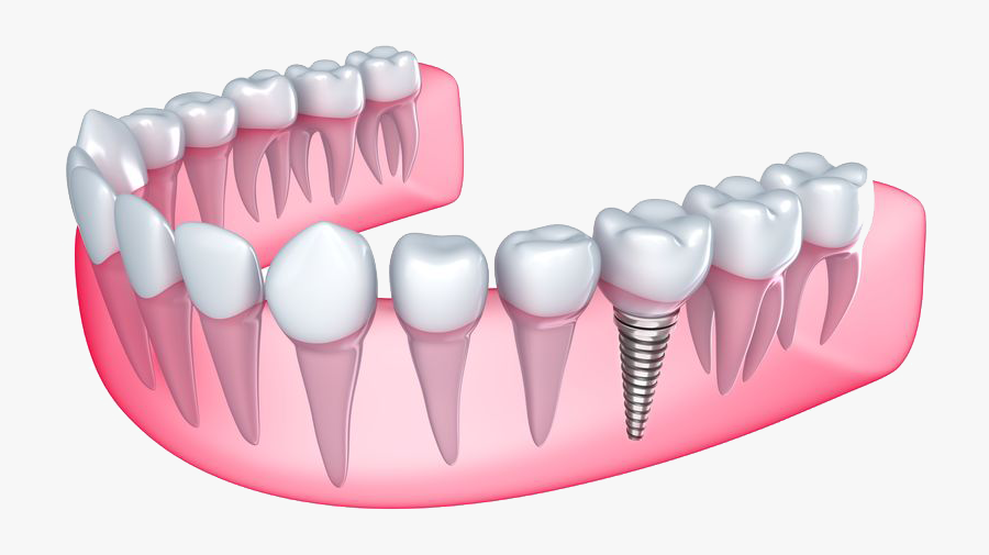 Sharp Teeth Implants, Transparent Clipart