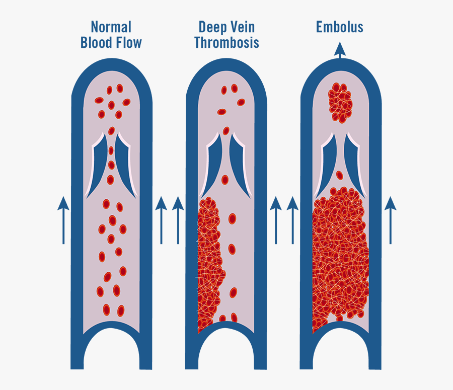 Image Of Thrombosis - Abnormal Blood Flow Thrombosis, Transparent Clipart