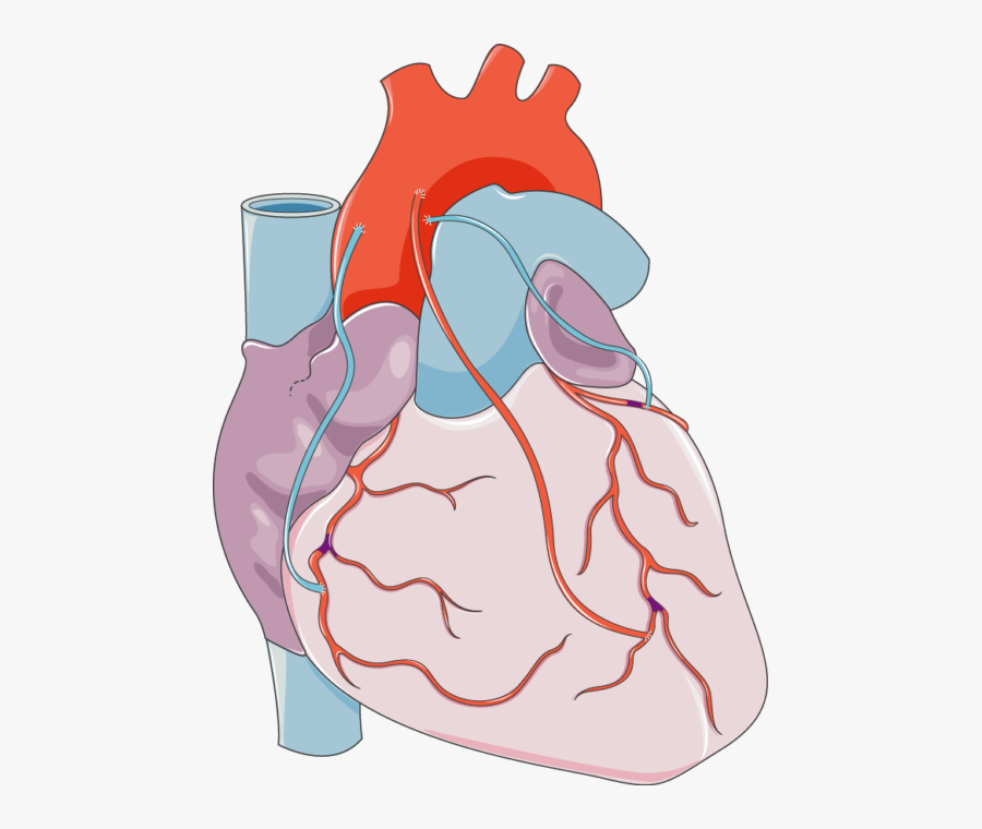 Clip Art Coronary Bypass Grafting Servier - Coronary Artery Png, Transparent Clipart
