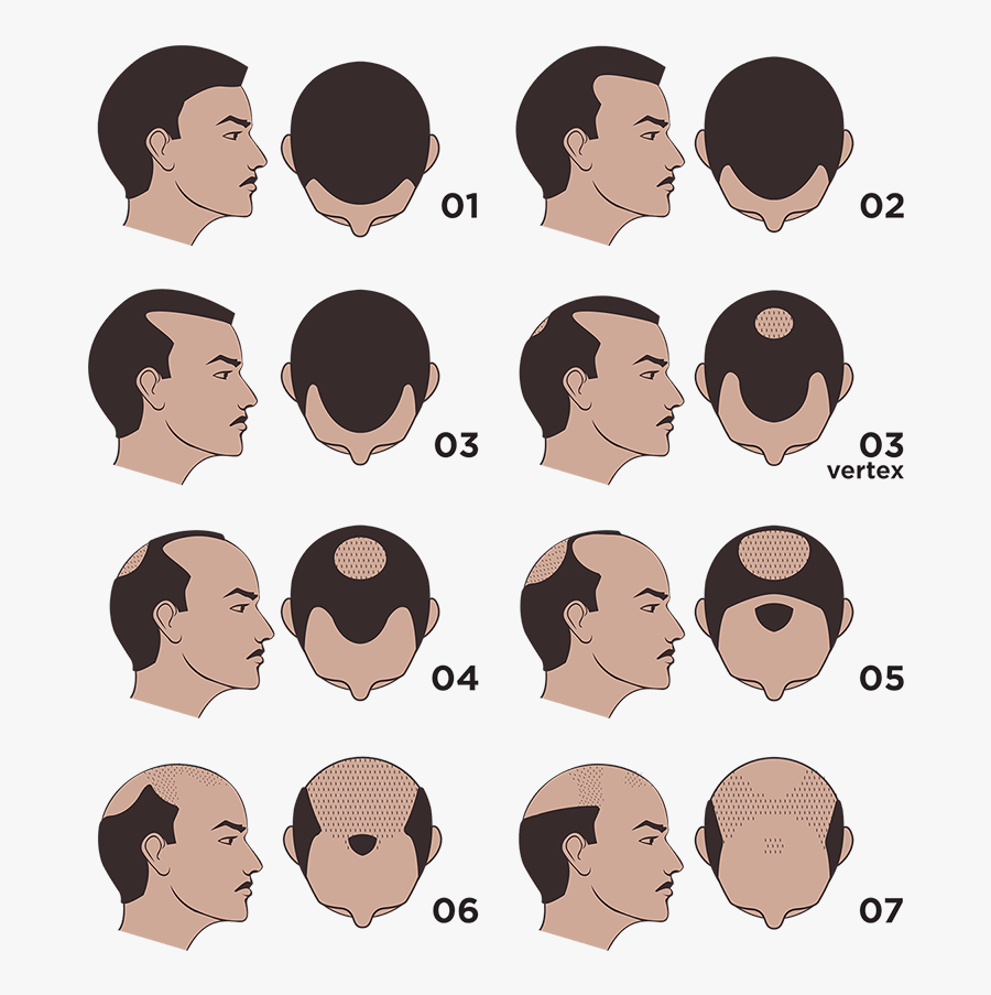 Completely Bald Head Tattooing Micropigmentation - Scalp Micropigmentation Scale, Transparent Clipart
