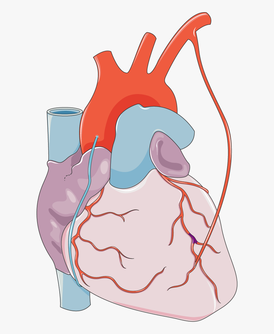 Pontage - Coronary Artery Png, Transparent Clipart