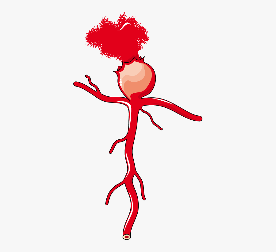 Anévrisme Berry - Aneurysm Transparent, Transparent Clipart