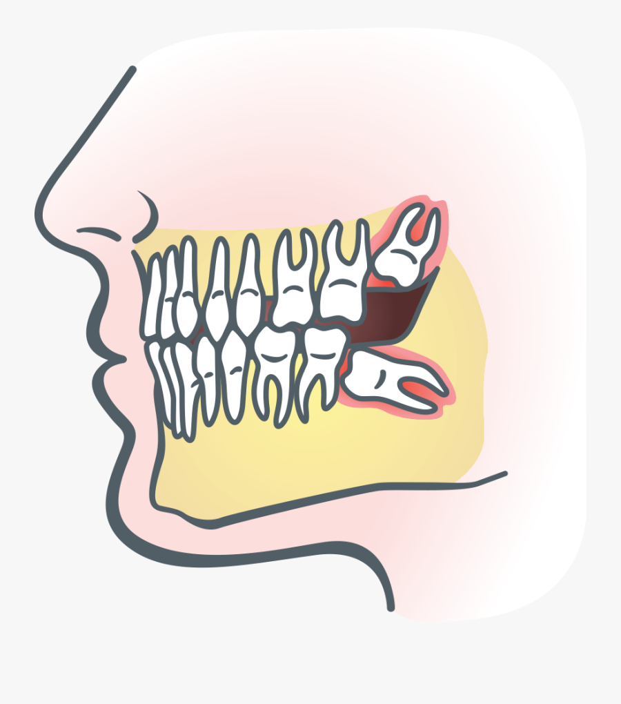 Clipart Mouth Bite - Wisdom Teeth Removal Drawing, Transparent Clipart