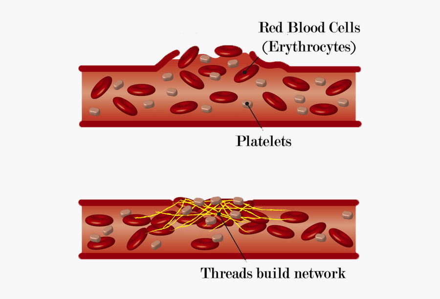 Damaged Blood Vessel, Transparent Clipart
