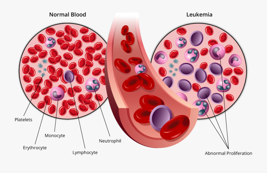 Acute Myeloid Leukemia Aml, Transparent Clipart