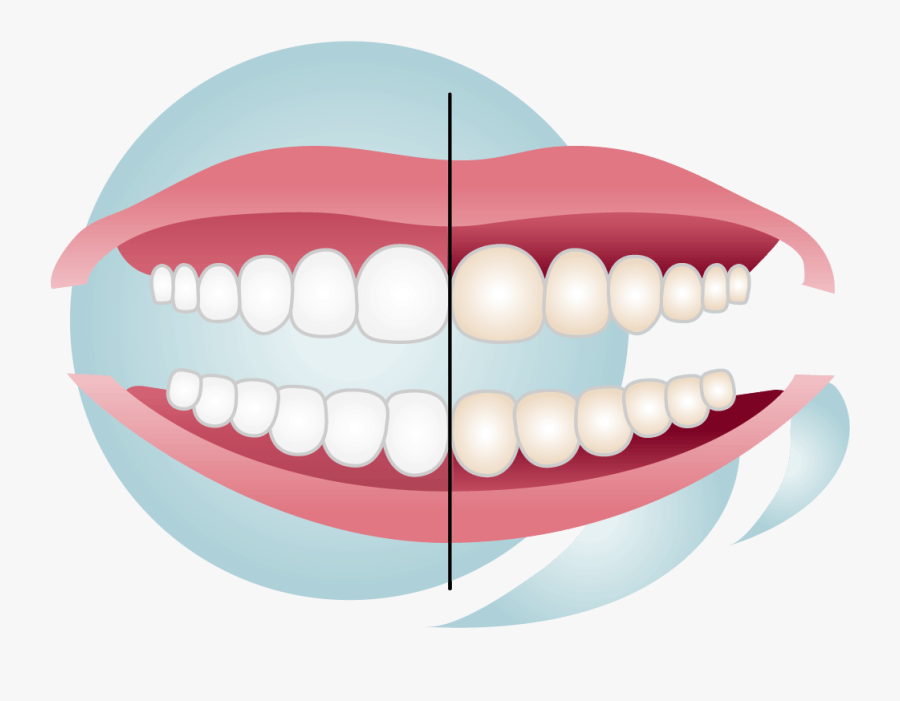 Whitening Discolored Teeth, Transparent Clipart